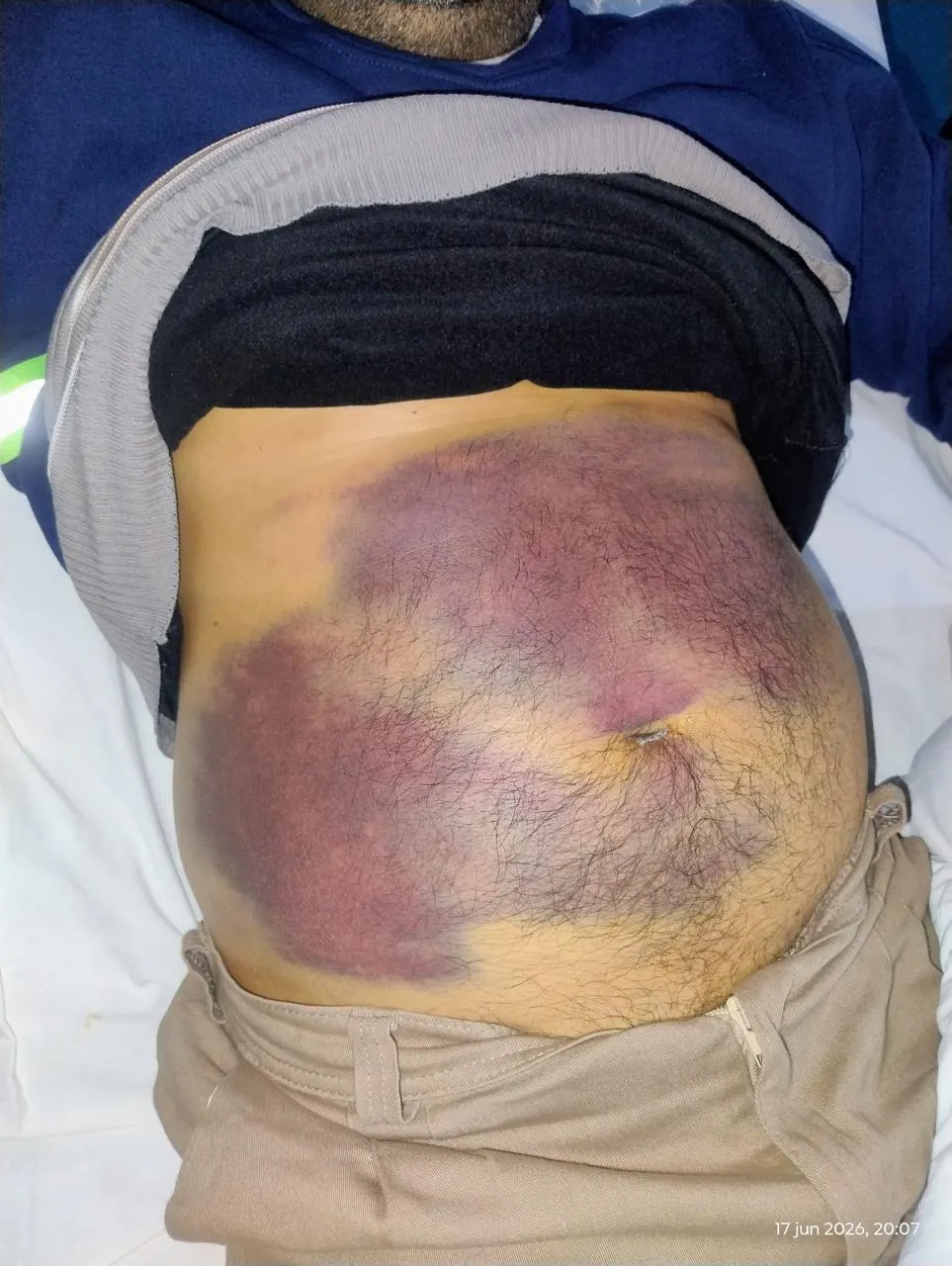 Los golpes recibidos les dejaron serias lesiones a los dos hombres maipucinos.