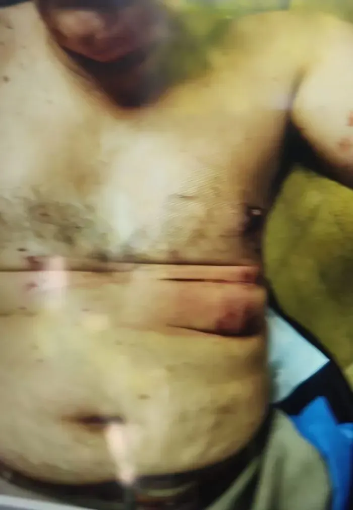 Las lesiones que recibió uno de los gendarmes heridos.