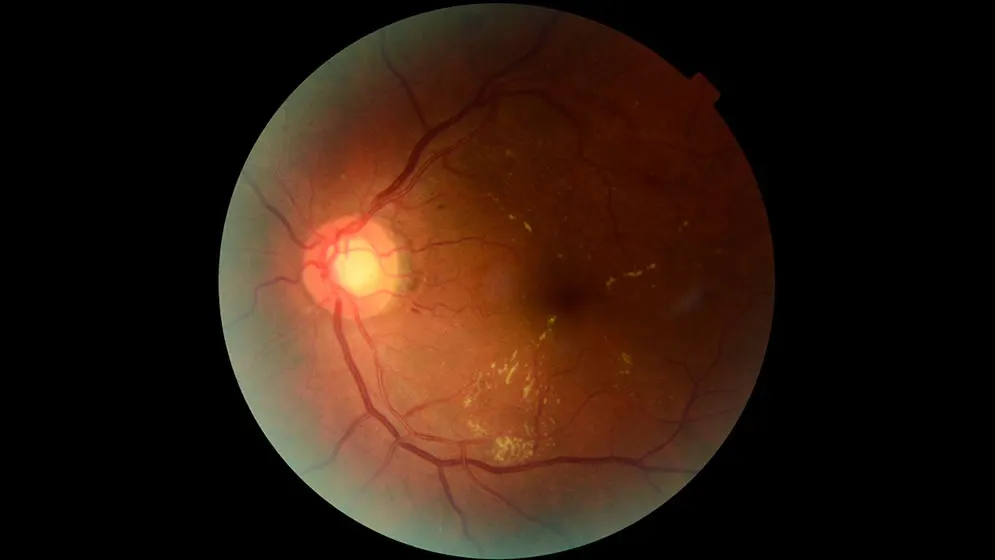 El sistema automatiza parte del análisis de imágenes de retina para que los especialistas puedan concentrarse en los casos de mayor riesgo.